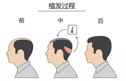 植发2.png