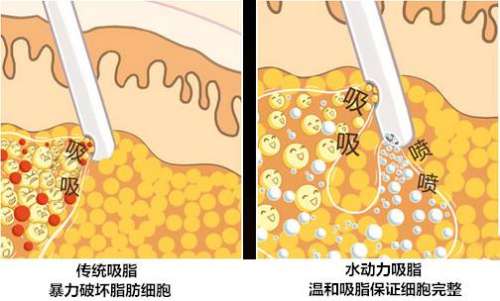 腰腹吸脂 (4).jpg