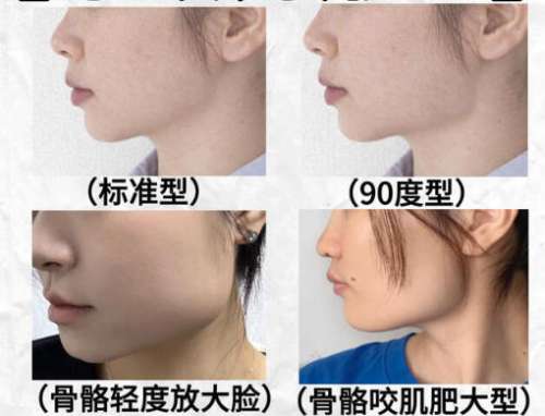 下颌角1.jpg