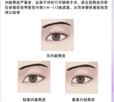 双眼皮