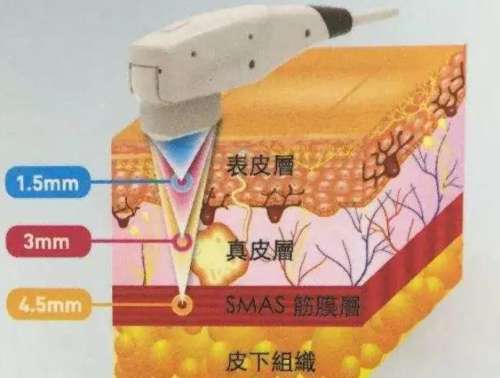 除皱