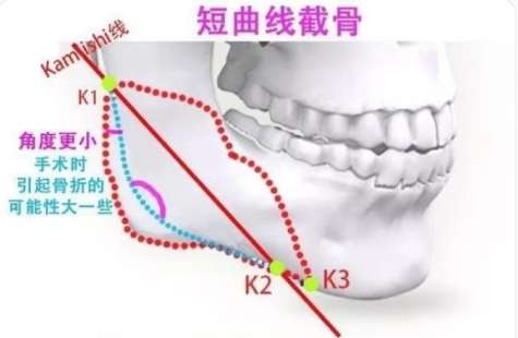 磨骨 磨骨