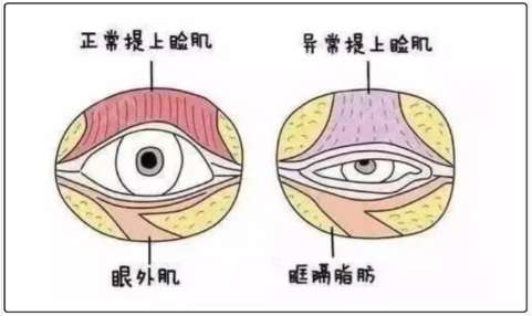 双眼皮