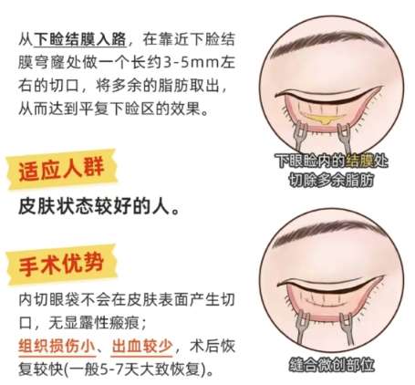 去眼袋