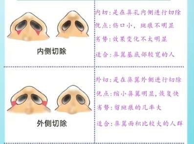 鼻翼缩小