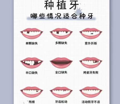 牙齿种植