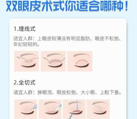 双眼皮