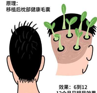 植发 植发