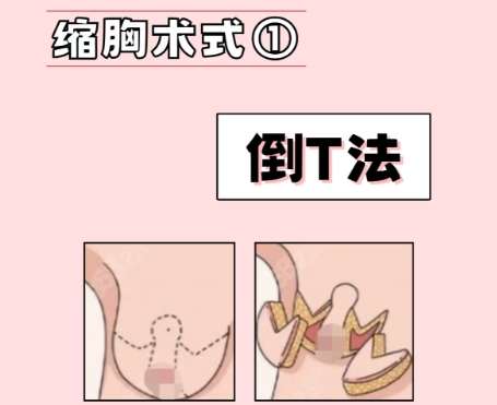 缩胸