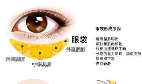 眼袋2.jpg