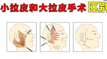 拉皮