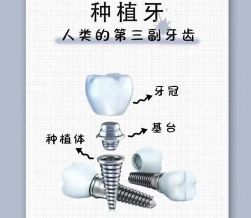 牙齿种植