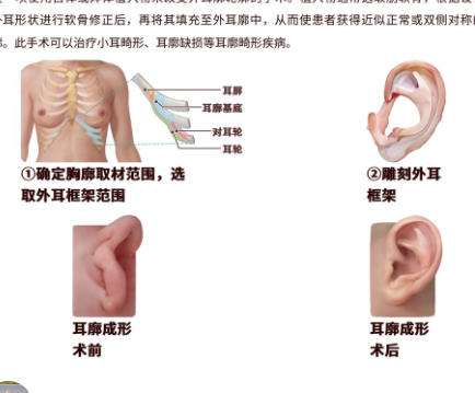 耳再造.jpg