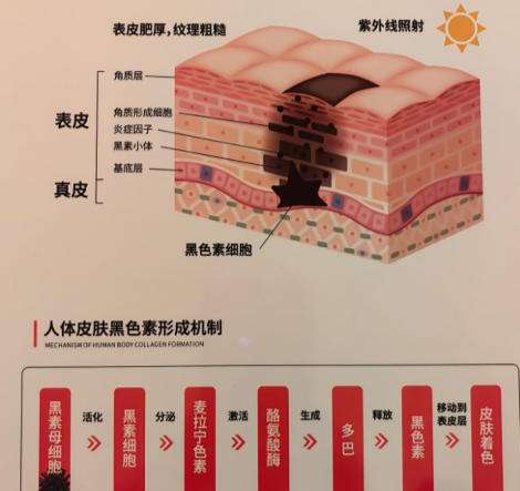 激光祛斑2.jpg