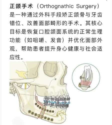 正颌 正颌