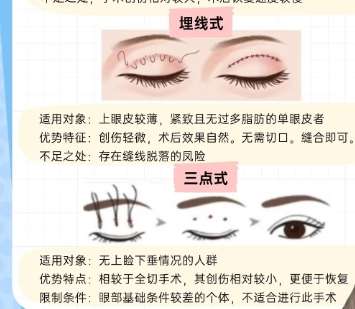 双眼皮