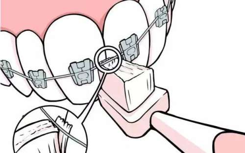 牙齿矫正动漫35.jpg