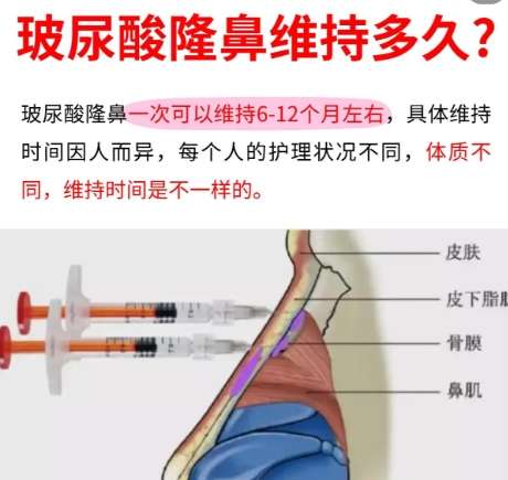 隆鼻