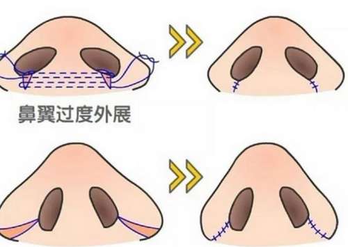 缩鼻翼.jpg