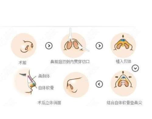 鼻综合1.jpg