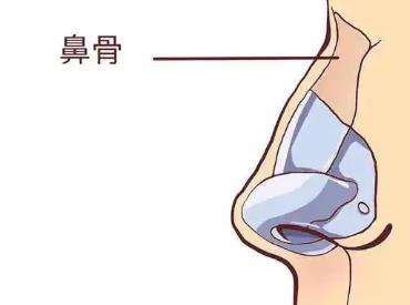 隆鼻