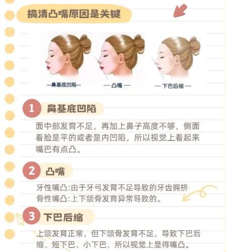 凸嘴矫正.jpg