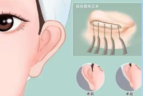 耳整形 耳整形