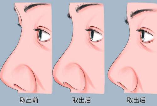 鼻假体