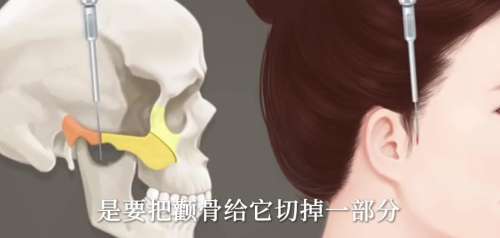 颧骨内推