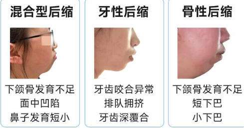 下巴后缩4.jpg