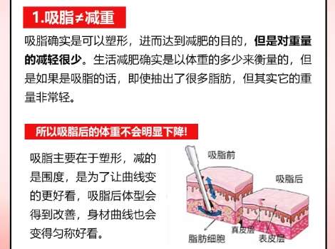 吸脂 吸脂