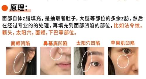 脂肪整形