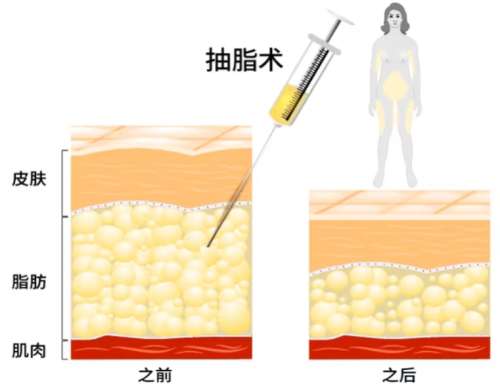 吸脂
