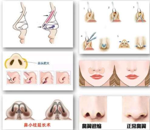鼻综合1.jpg