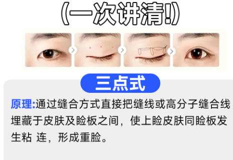 双眼皮6.jpg 双眼皮6.jpg