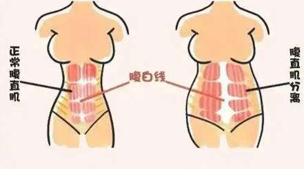 腹壁整形