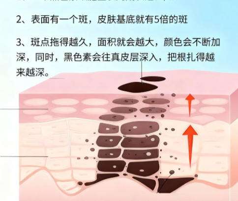 激光祛斑1.jpg