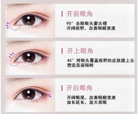 开眼角