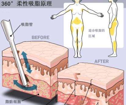 抽脂2.jpg