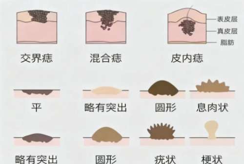 切痣3.jpg