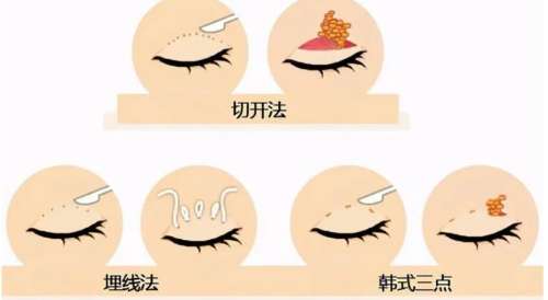 双眼皮手术原理动漫3.jpg