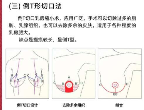 缩胸3.jpg