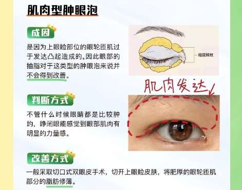 双眼皮