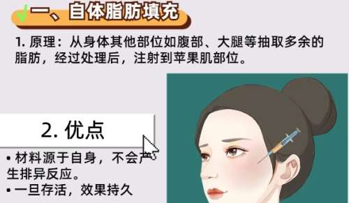 脂肪填充