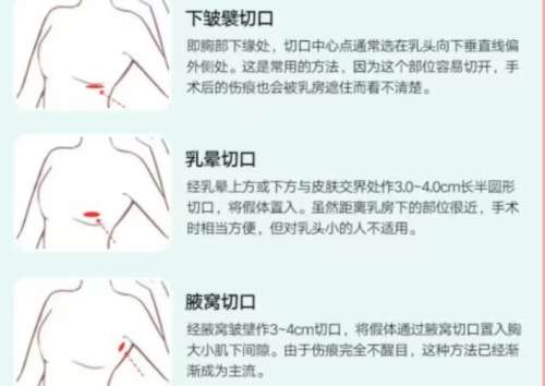 隆胸