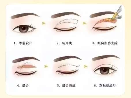 双眼皮
