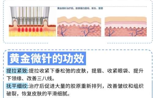 黄金微针