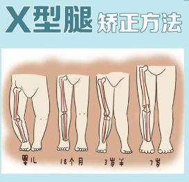 四肢畸形矫正