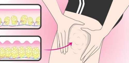 大腿吸脂 大腿吸脂