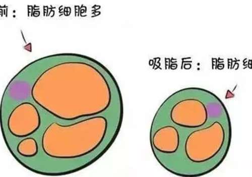 吸脂 吸脂